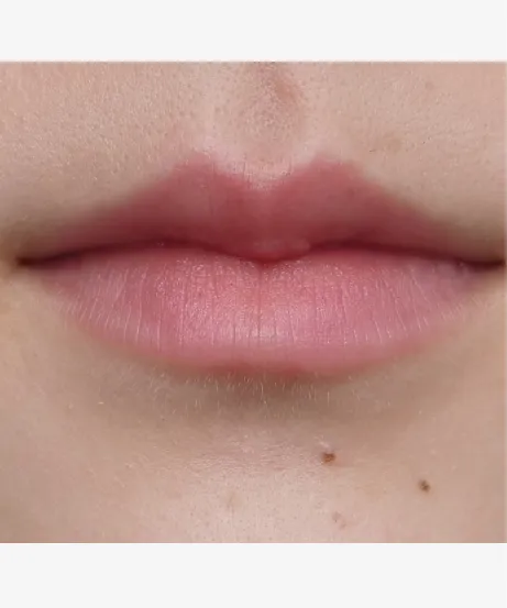 ヒアルロン酸注射 BEFORE画像