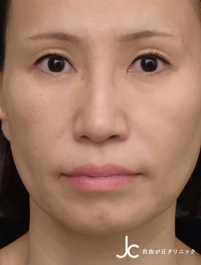 上まぶたのたるみ取り（眉毛下皮膚切除）担当医：坂田芳洋AFTER画像