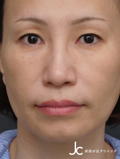 上まぶたのたるみ取り（眉毛下皮膚切除）担当医：坂田芳洋BEFORE画像