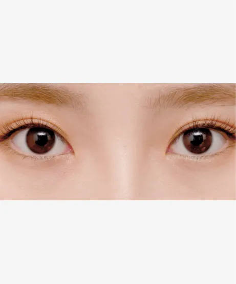 ヒアルロン酸注射 BEFORE画像