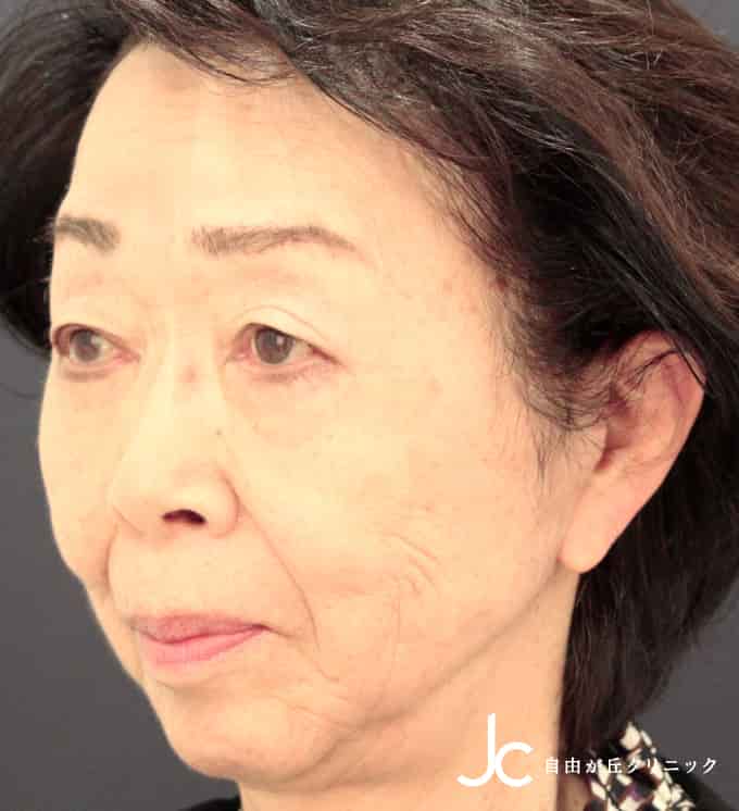フェイスリフト SMASリフト法（術後3カ月）担当医：武田 啓AFTER画像