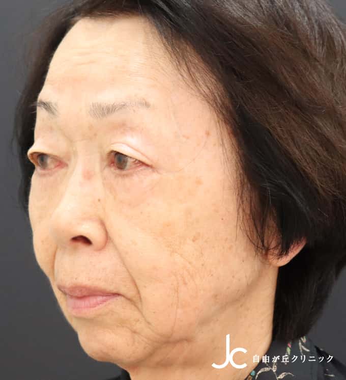 フェイスリフト SMASリフト法（術後3カ月）担当医：武田 啓BEFORE画像