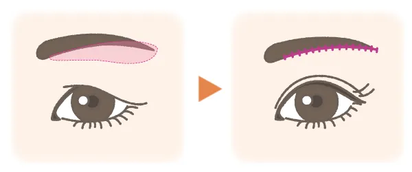 眉毛下皮膚切除のイメージ画像