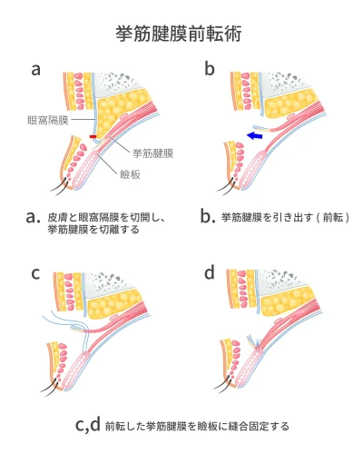 挙筋腱膜前転術のイメージ画像