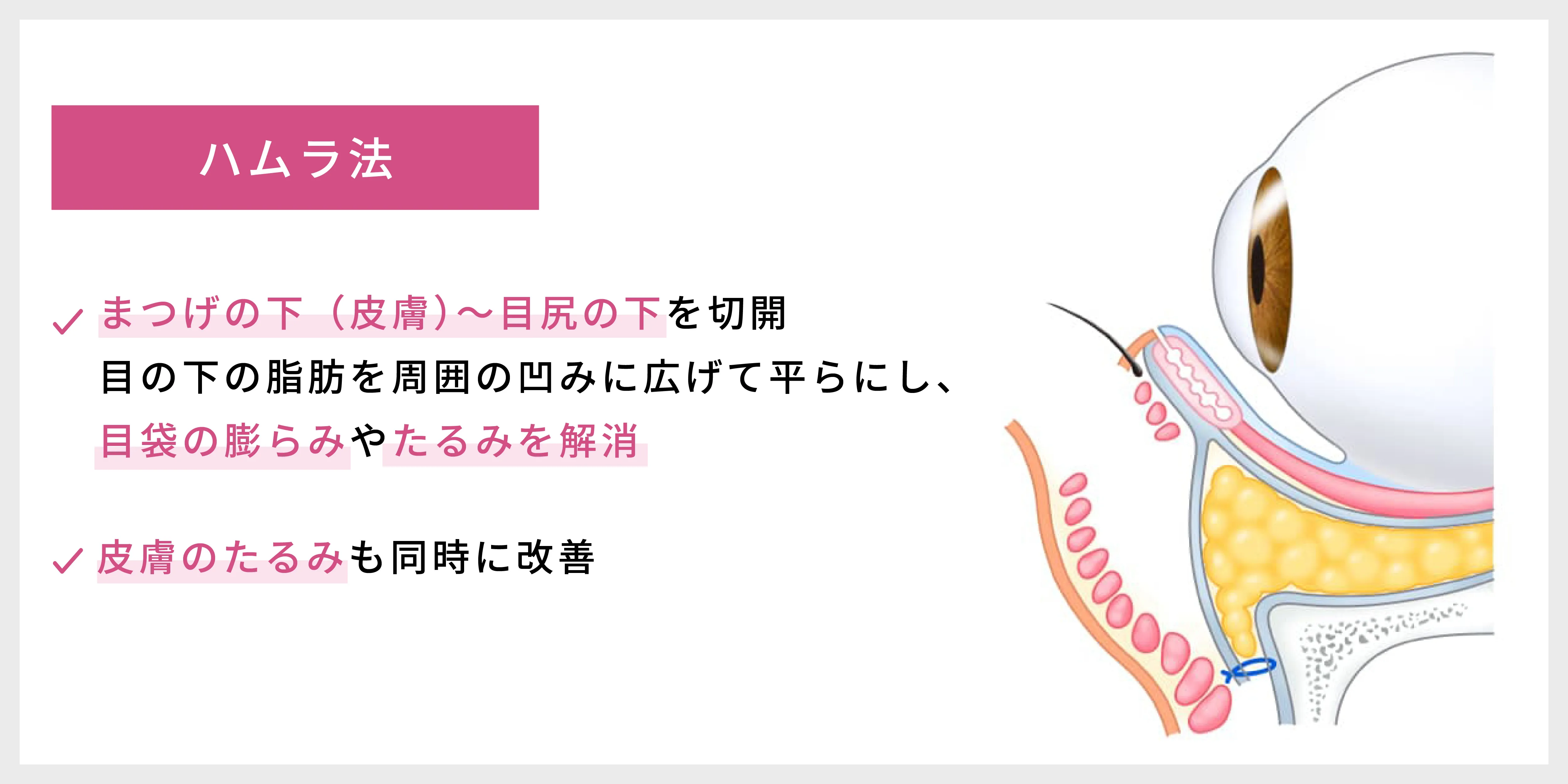 ハムラ法の治療詳細