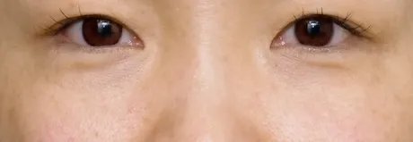 プルリアルデンシフィアシリーズ AFTER画像