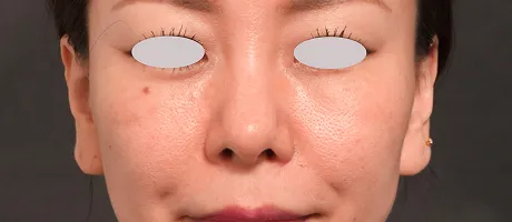 高濃度W-PRP+ダーマペン4 AFTER画像