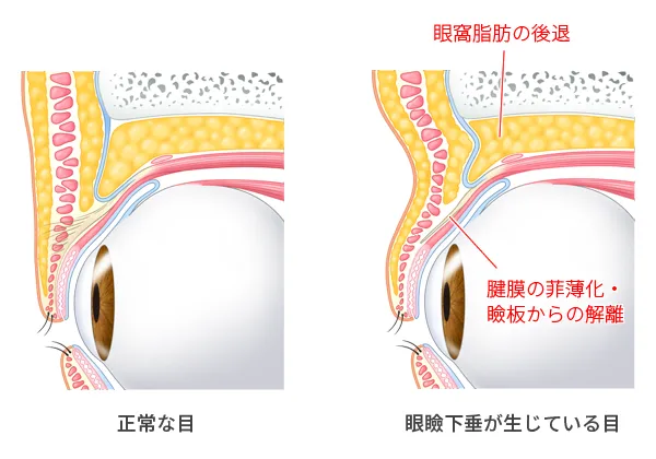 眼瞼下垂のイメージ