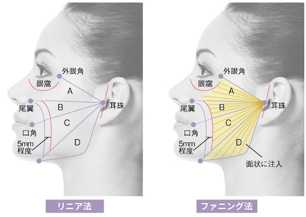 リニア法・ファニング法の解説画像