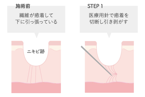サブシジョンの解説図解