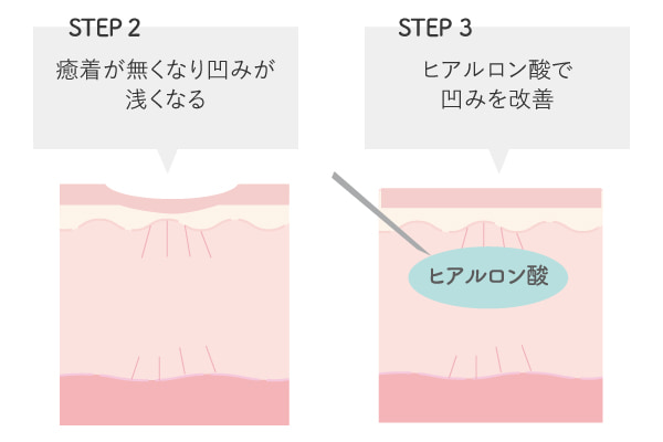 サブシジョンの解説図解