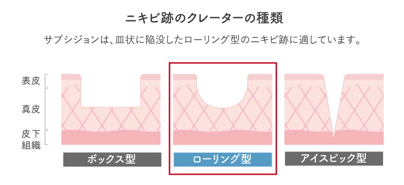 ニキビ跡のクレーターの種類。ローリング型に特に適しています。