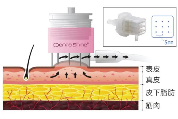 水光注射（ダーマシャインプロ）の特徴・仕組み