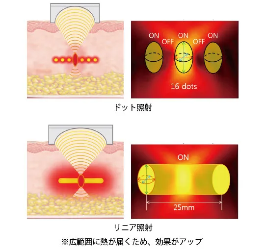 ウルトラセルQプラスリニアHIFU4.5の施術イメージ