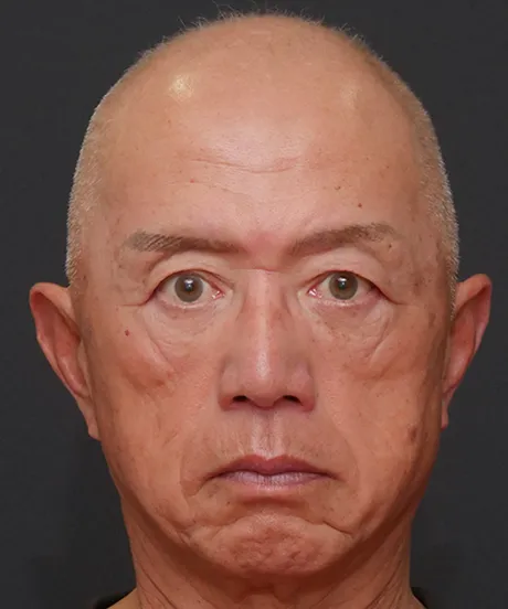 上まぶたのたるみ取り（眉毛下皮膚切除） BEFORE画像