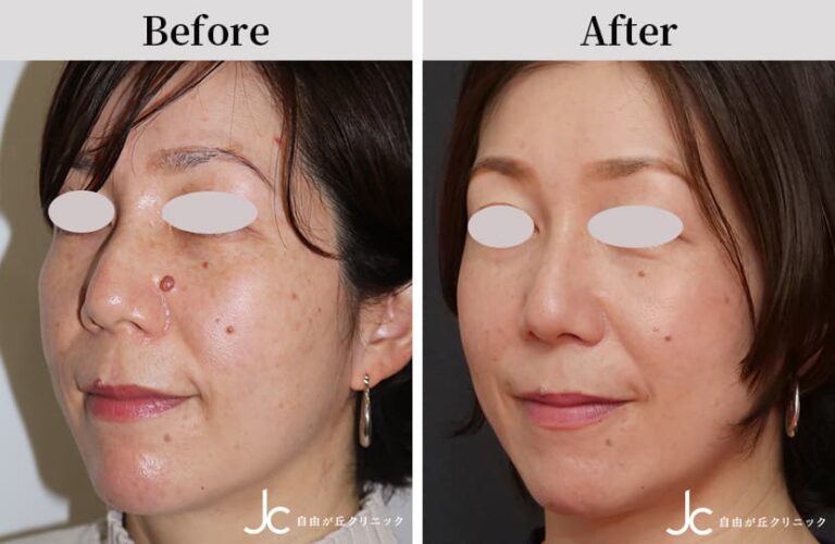 ホクロ除去の症例:施術前