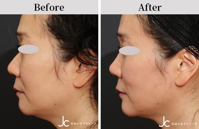 コンビネーション治療の症例:施術後